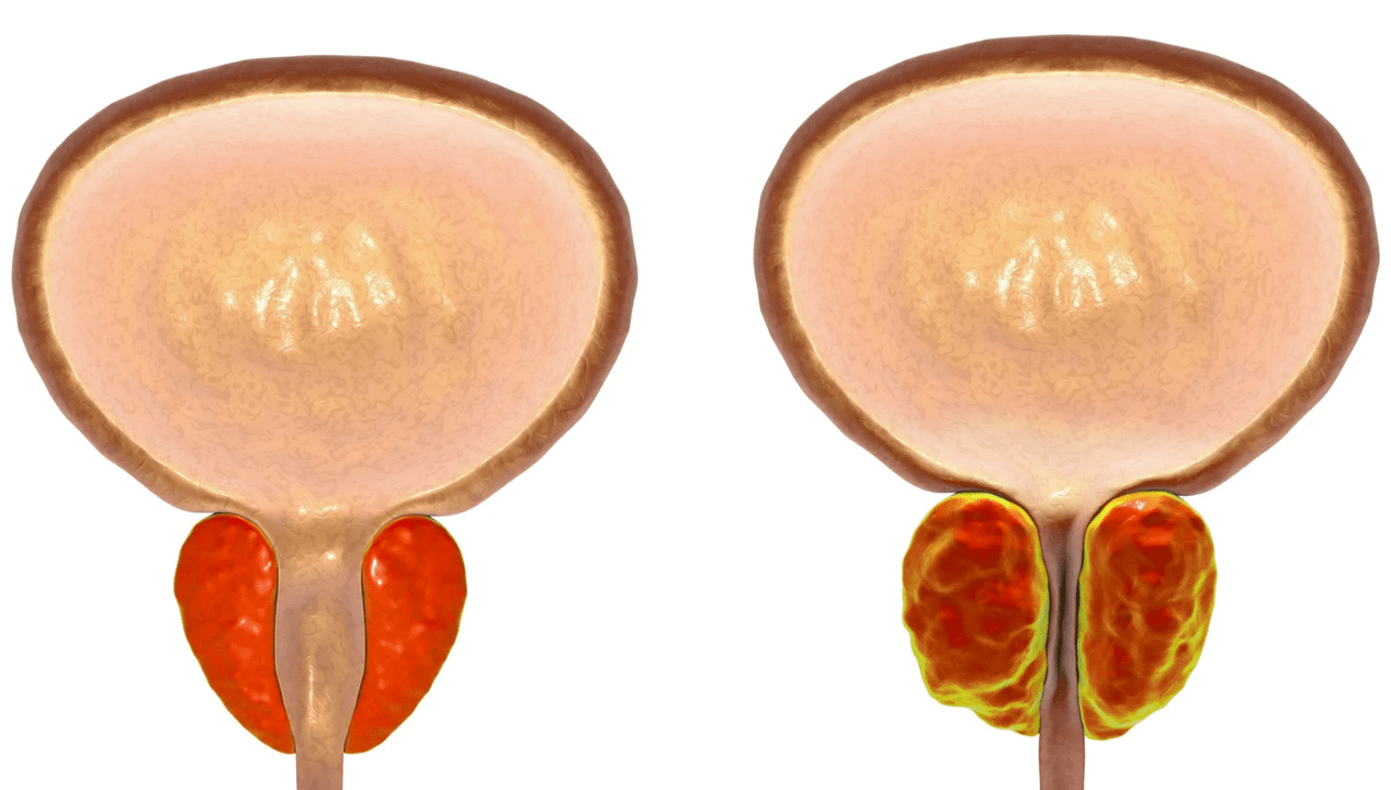 Qu'est-ce que la prostatite